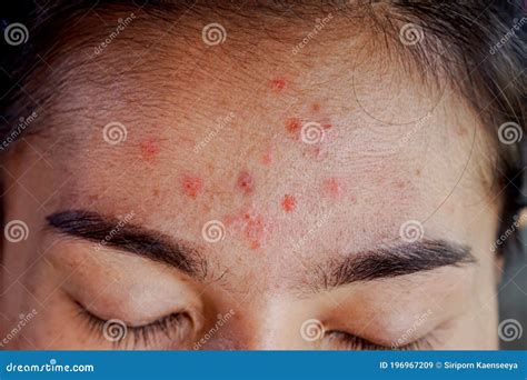 Closeup Acne On Forehead Of Asian Woman Teen Face With Rash Skin