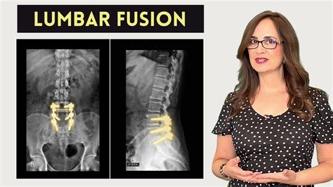 110 Lumbar Fusion Surgery Can You Exercise Youtube