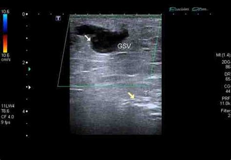 Occluded Distal Great Saphenous Vein GSV In The Leg The White Arrow