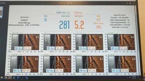 fibroscan results back -- sad :( : r/nafld