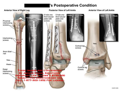 Amicus Illustration Of Amicussurgerypostoperativeconditionleginterlockingscrewstibial