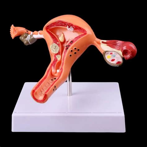 Pathological Uterus Ovary Anatomical Model Anatomy Cross Section Study