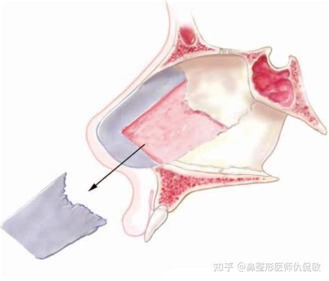 鼻修复（鼻中隔重建的材料） 知乎