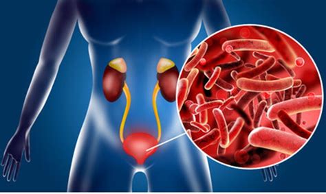 Understanding Urinary Tract Infections UTI Urology Clinics Of North