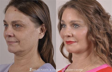 Dermabrasion Before And After English Plastic And Cosmetic Surgery