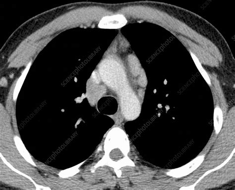 Hodgkins Lymphoma Ct Scan Stock Image C0226850 Science Photo Library