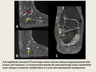 Presentation Radiological Imaging Of Lateral Hindfoot Impingement Ppt