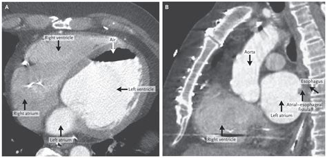 A Case Of Atrial Oesophagal Fistula With Gas In Left Atrium And Ventricle