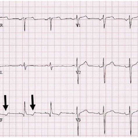 (PDF) Respiratory T-Wave Inversion in a Patient With Chest Pain