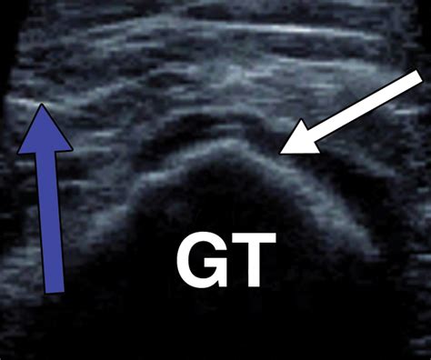 Iliopsoas Bursitis Ultrasound