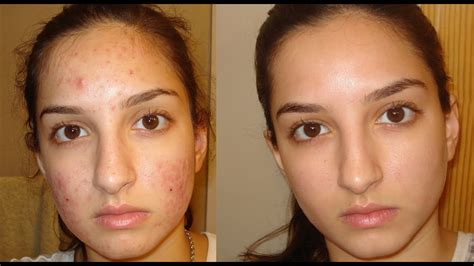 A True Miracle How I Got Rid Of My Acne Daily Skin Care Routine