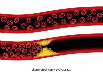 Arteriosclerosis Infarct Ischemia Thrombosis Disease Cholesterol Stock