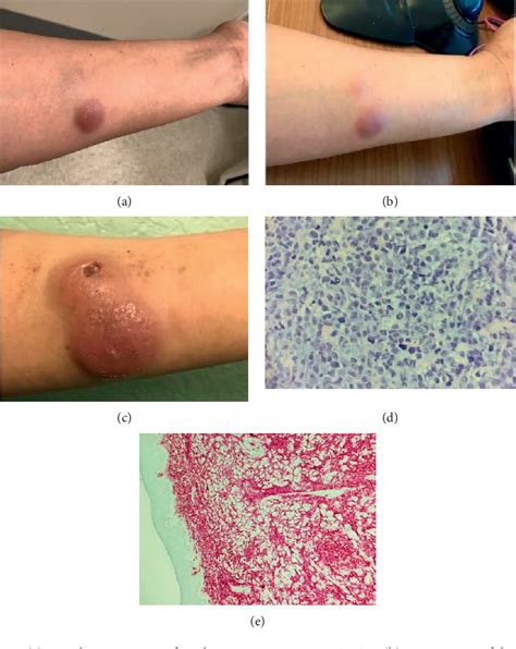 Figure 1 From Primary Cutaneous Diffuse Large B Cell Lymphoma Of The