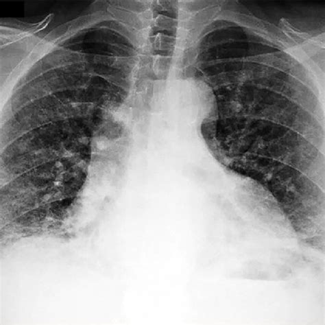 Open lung biopsy. Open lung biopsy showing extensive areas of... | Download Scientific Diagram