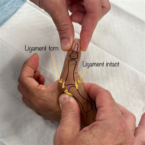 Thumb Ulnar Collateral Ligament Ucl Repair Dr Oscar Brumby Rendell