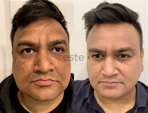 Cosmelan Peel Before After Pigmentation Treatment Results Este