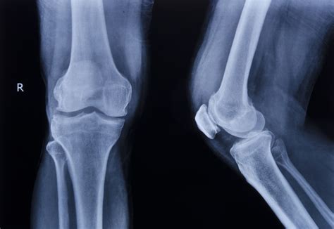 Broken Bones - Perenich, Caulfield, Avril & Noyes Personal Injury Lawyers