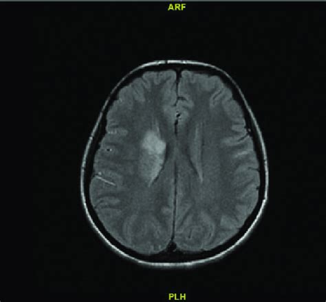 Acute Infarct Of Right Parietal Region On Diffusion Mri Download Scientific Diagram