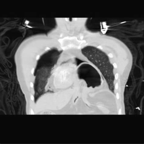 Ct Scan Of The Chest Coronal View Showing Pneumothorax Download