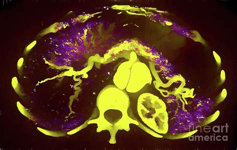 Aortic Dissection By Vsevolod Zviryk Science Photo Library