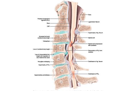 Acute Complications Of Spinal Cord Injury Sci Top Neuro Docs