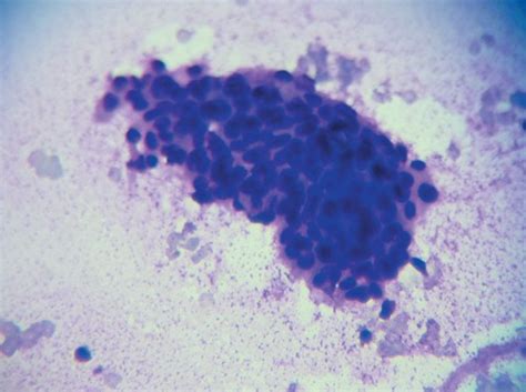 Cytology Smear Showing Cohesive Cluster Of Cells With Moderate Download Scientific Diagram