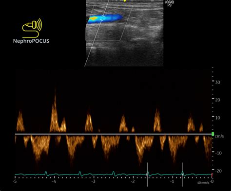 NephroPOCUS On Twitter Bonus Neck VExUS Https T Co NrofeE0JBi
