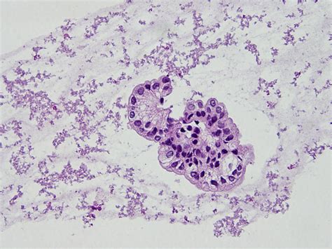 Peritoneal Fluid Analysis