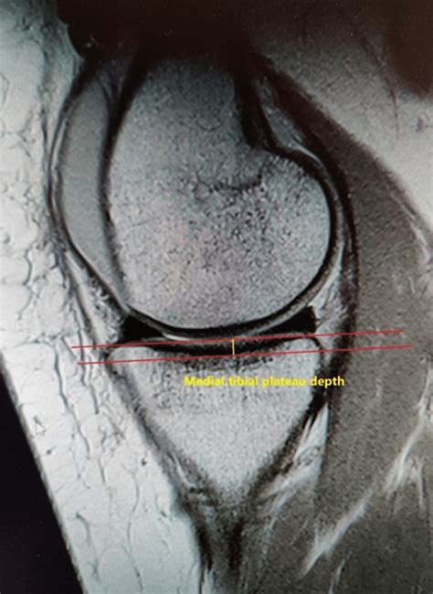 Measurement Of The Depth Of The Medial Tibial Plateau In A Mid Sagittal Download Scientific