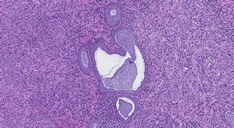 Squamous Cell Carcinoma Of The Cervix Ottawa Atlas Of Pathology