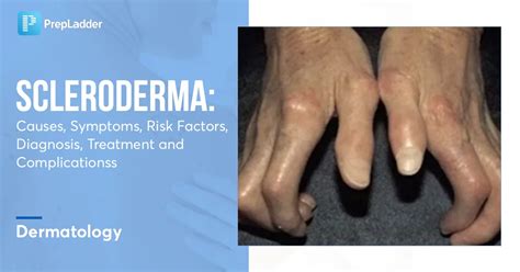 Scleroderma: Causes, Symptoms, Risk Factors, Diagnosis, Treatment and ...