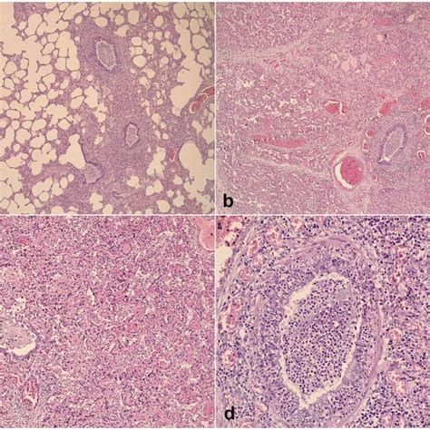 A Disseminated Bronchopneumonia Focus Of Inflammatory Condensation Download Scientific