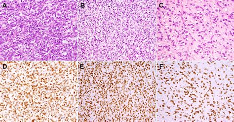 Nuclear Expression Of Ddit3 Distinguishes High Grade Myxoid Liposarcoma