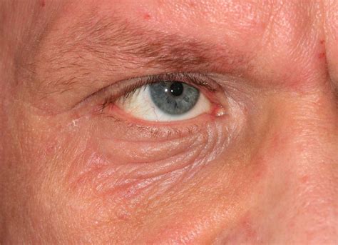 Eyelid Margin Disease Types And Treatment