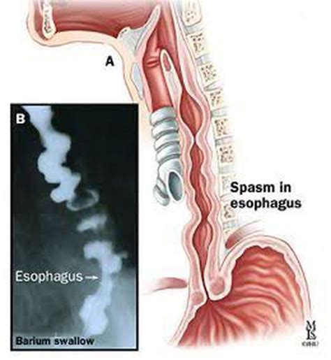 Diffuse Esophageal Spasm