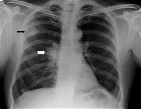 11 Normal Chest X Ray Vs Copd Us Ron J Moen