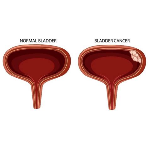 Bladder Cancer Warning Signs Dr Sumit Sharma Urologist Blog