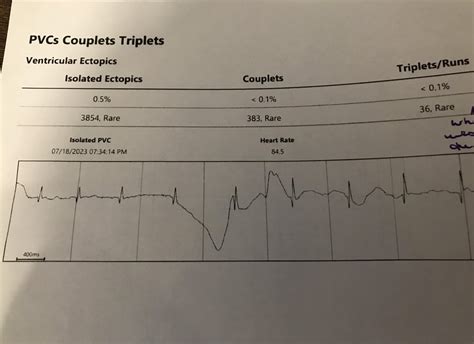 Understanding Holter Monitor Results Raskcardiology