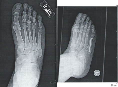 Jones Fracture | Podiatrist Carlsbad | Dr. Keenan Carriero DPM ...