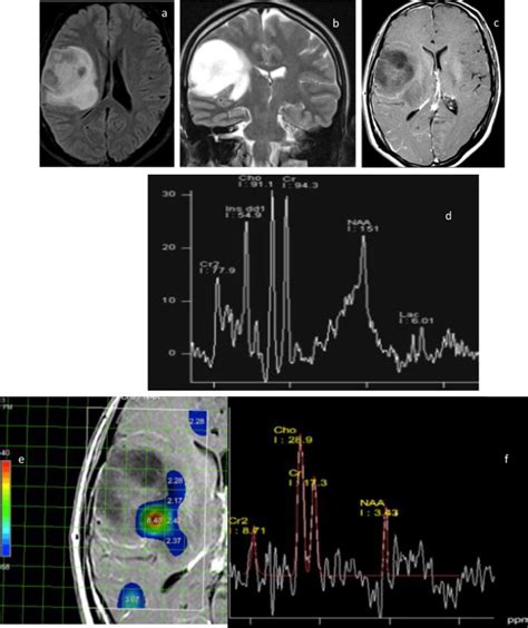 Grade Ii Astrocytoma A Axial Flair B Coronal T Wi C