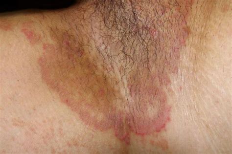 Tratamiento Para La Ti A Inguinal O Hongos En La Entrepierna De Hombres