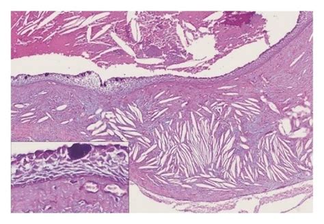 Radicular Cyst Histology