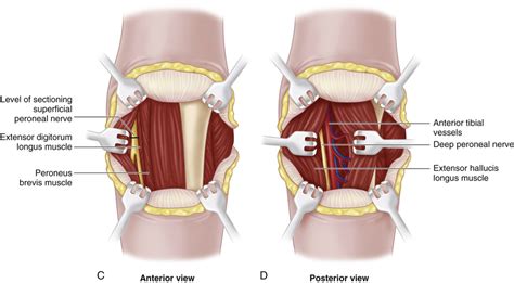 57 Below Knee Amputation Musculoskeletal Key