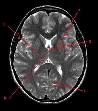 Brain Sectional Anatomy Diagram Quizlet