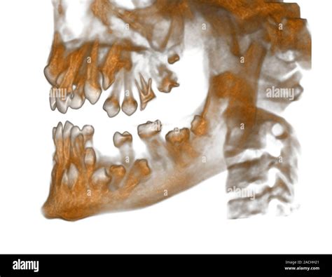 Displasia Cleidocraneal 3d Ct Scan Vista Lateral De Haz Cónico En 3d