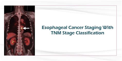 ESOPHAGEAL CANCER STAGING WITH TNM STAGE CLASSIFICATION