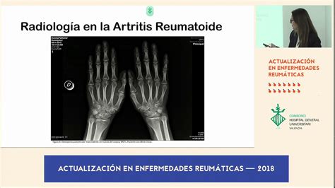 Artrosis Versus Artritis Reumatoide Diferencias Radiológicas Y De Laboratorio Youtube