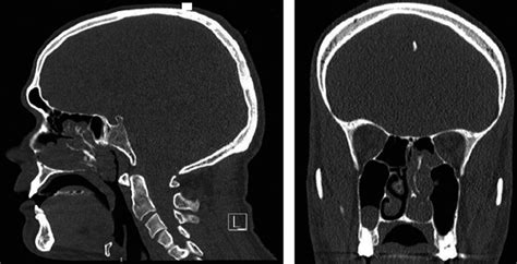 Nasal Polyps With Osseous Metaplasia A Misunderstood Situation Mat