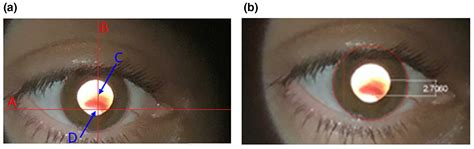 Rizzuti Sign Keratoconus