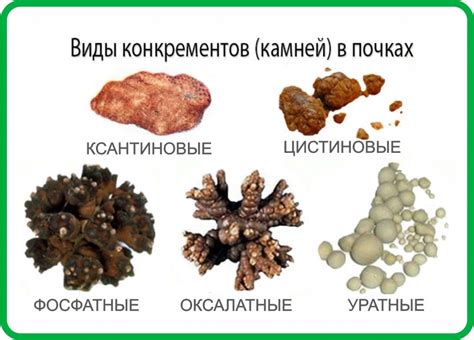 Как выглядит моча с песком